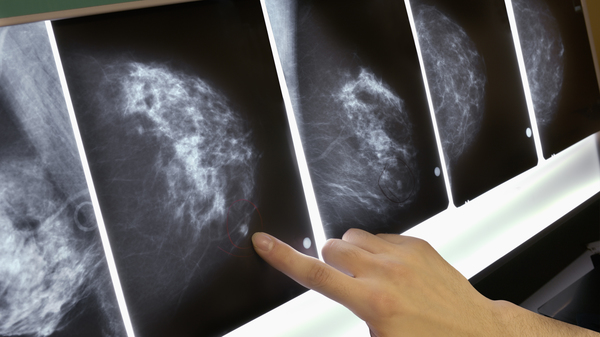 Women with a common form of breast cancer may be able to safely forgo chemotherapy, depending on the results of a genetic test.